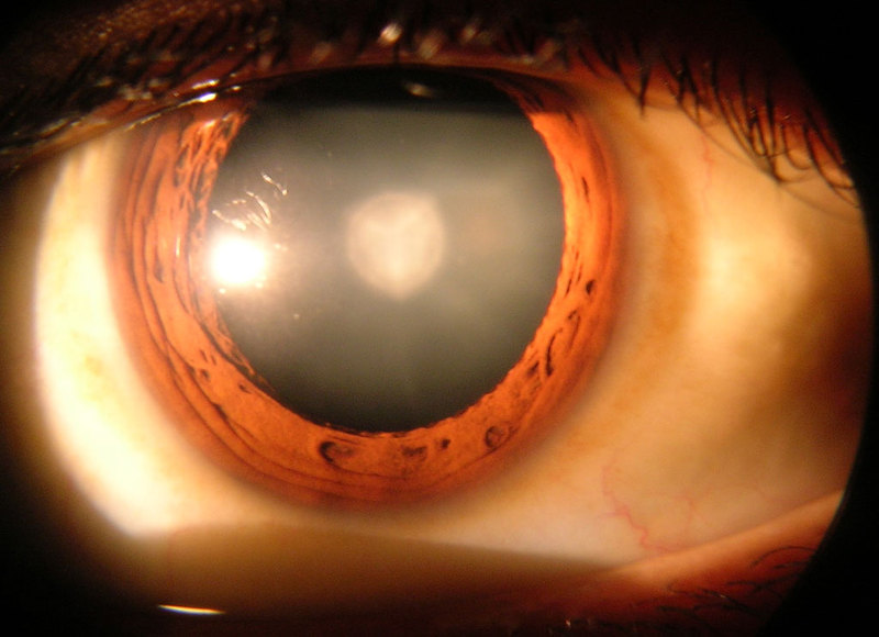 kataraktos pažeista akis